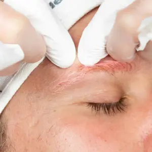 Pro Clear – Hỗ trợ giảm mụn và bã nhờn